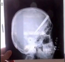 Обломок ножа в мозге бразильца, кадр, переданный в эфире телеканала Repubblica