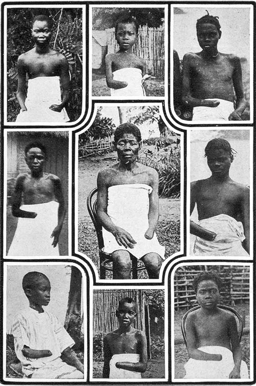 Покалеченные жители Конго. wikipedia