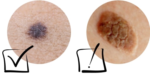 Как распознать меланому кожи: диаметр больше 5 мм