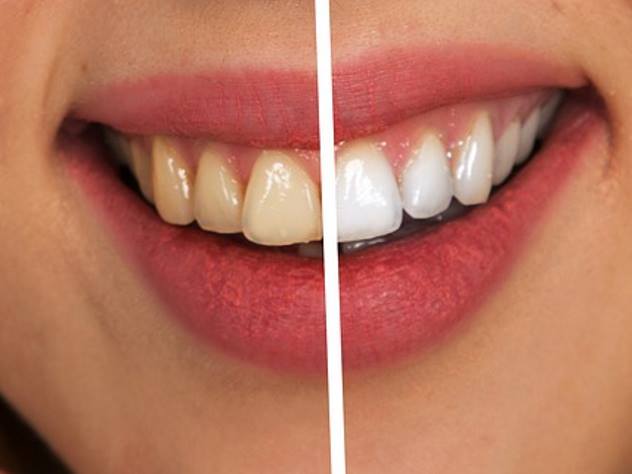 Восстановить зубную эмаль можно с помощью нового прочного материала