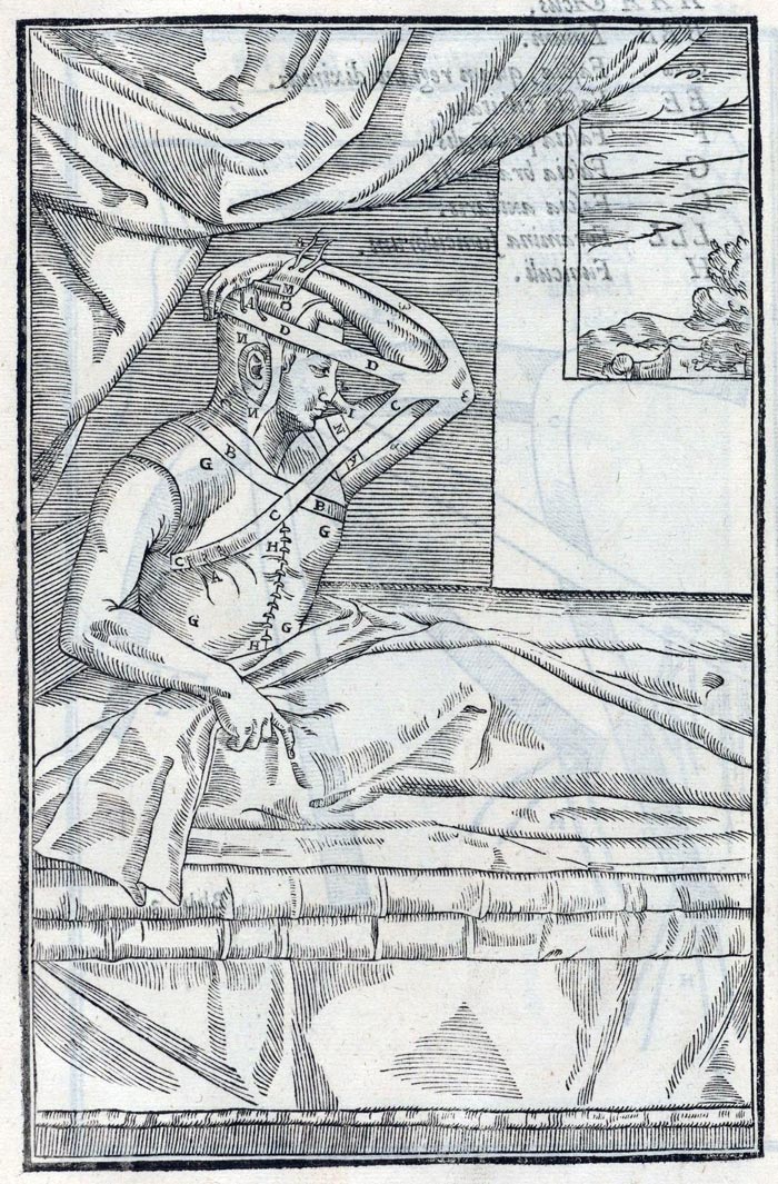 «Итальянский метод» ринопластики, разработанный Гаспаре Тальякоцци в 1597 году. Источник: wikimedia