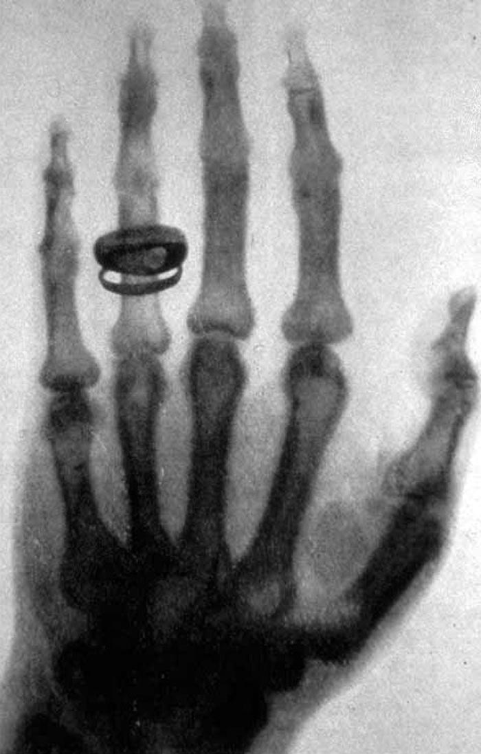 Сделанная В. К. Рентгеном фотография (рентгенограмма) руки своего ассистента Альберта фон Келликера. Источник wikimedia.org