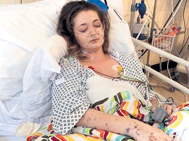 25-летняя британка Шарлин Колчин выложила шокирующие фото, чтобы предупредить об опасности бактериальной инфекции. Сначала появилась сыпь, потом стали отказывать органы… Девушку спасли чудом