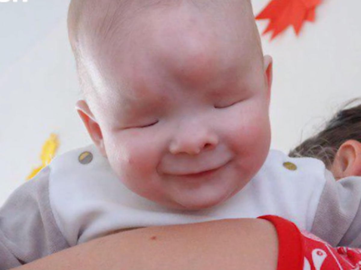В Томске ребенок родился без глаз