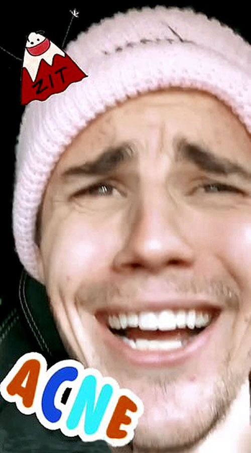 Джастин не скрывает, что лечится от акне