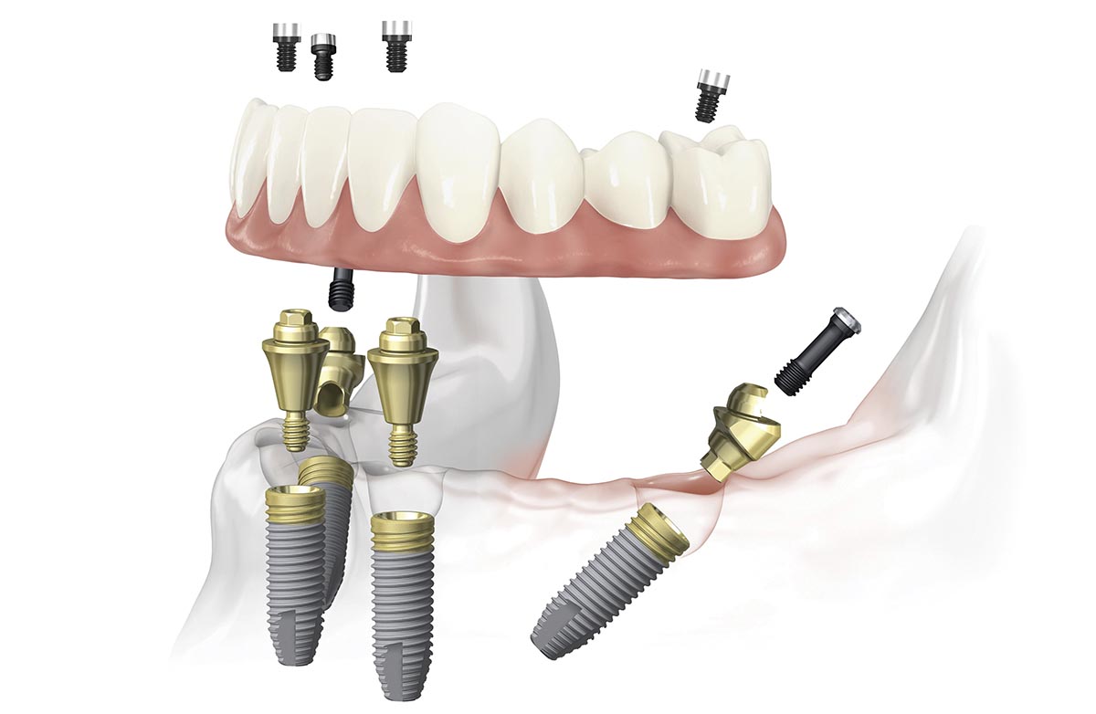 Четырех имплантов может быть достаточно для поддержки протеза на всю челюсть. Фото: Smile-at-Once