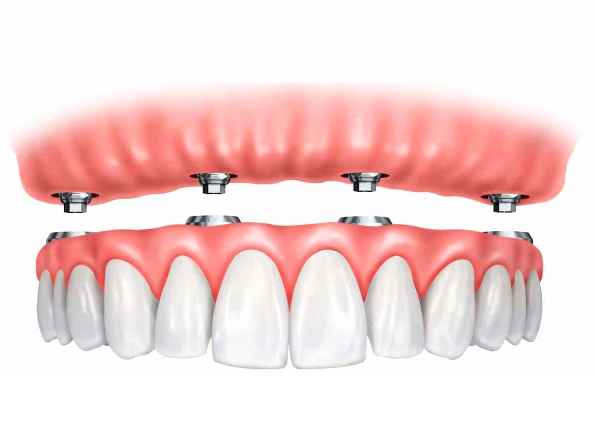 Протез «Всё на 4 имплантах»: новые зубы быстро и на всю жизнь