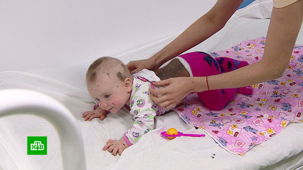 Дети с родимыми пятнами: