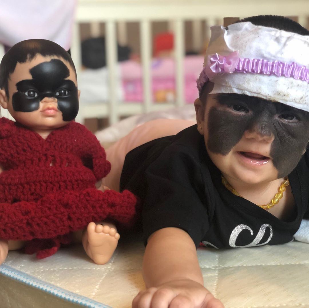 Дети с родимыми пятнами: