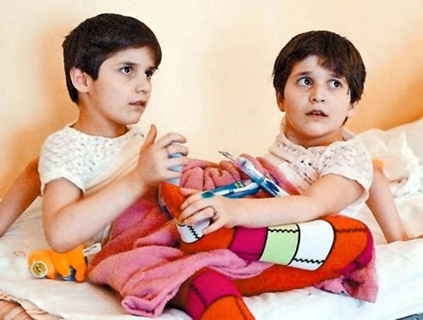 Сиамские близнецы Резахановы оказались медицинской загадкой, разгадать которую не могут до сих пор