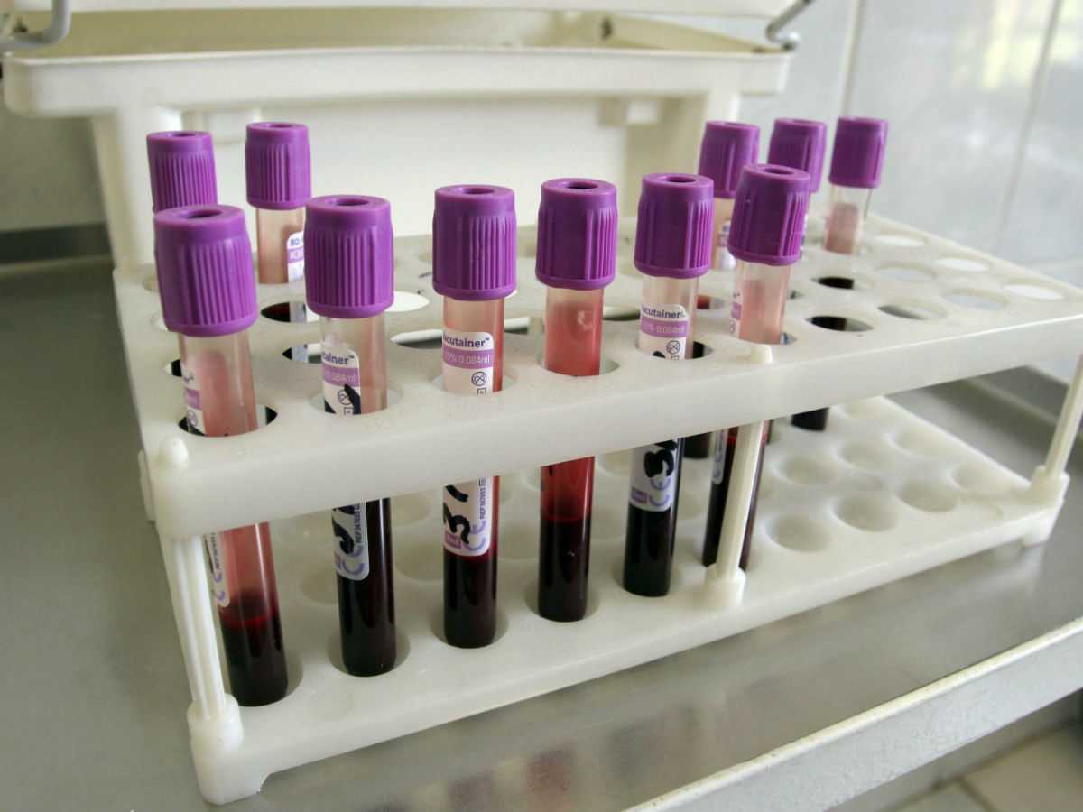 Сколько стоит общий анализ крови?