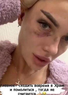 Екатерина Скалон показала фото после избиения