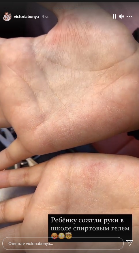 Руки Анджелины обожжены спиртовым гелем