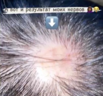 Звезда Дома-2 лысеет из-за стресса