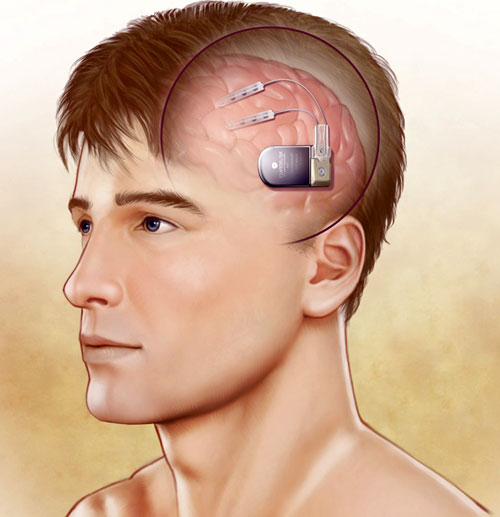Технологии подключения мозга к компьютеру тестируют на молодых, а пользоваться изобретением будут старики-олигархи
