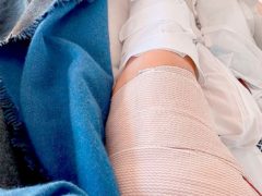 Из-за перелома  и инфекции пришлось  наложить на ногу гипс,  а на руку — бандаж