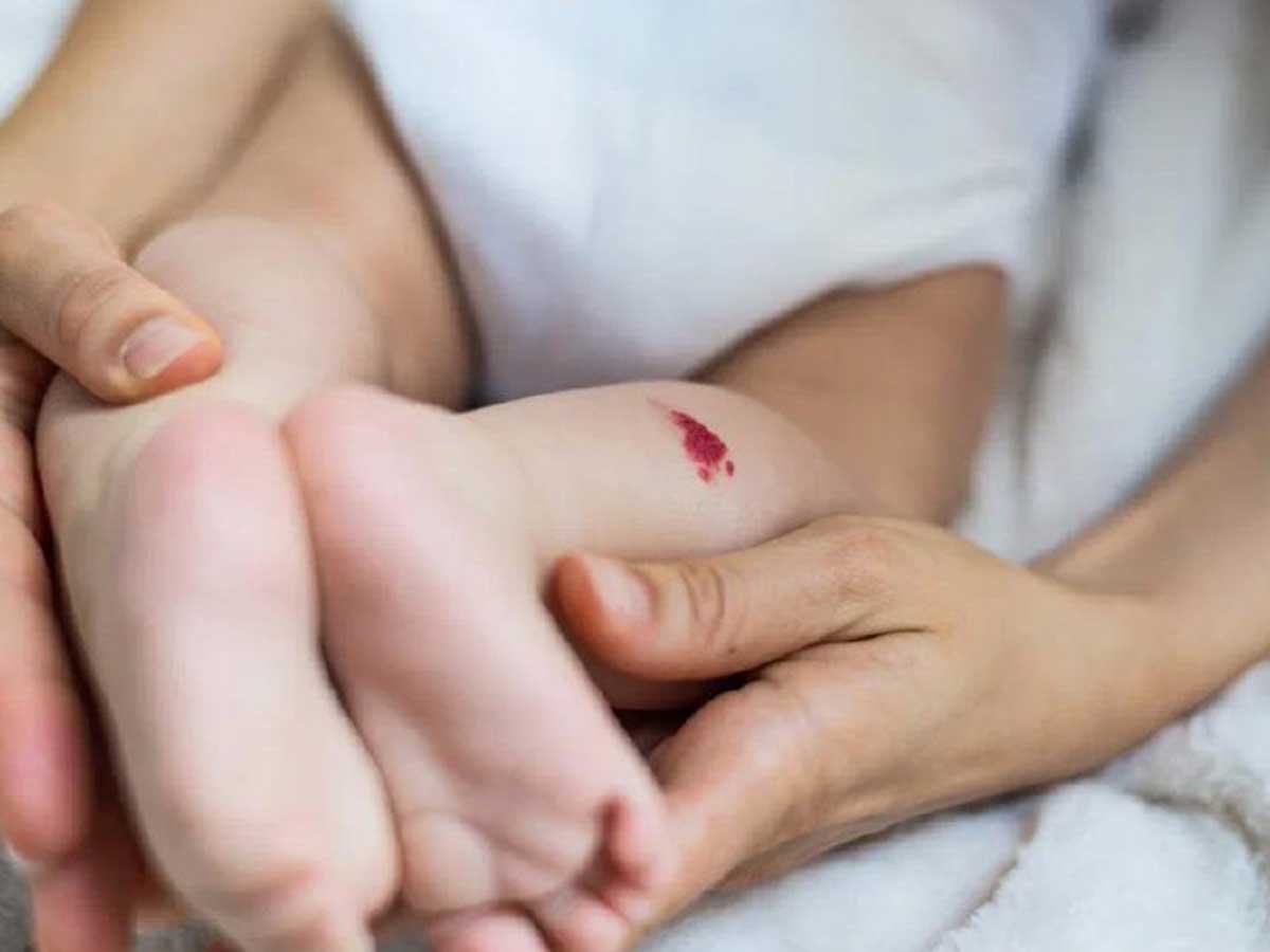 Удаление гемангиом у детей