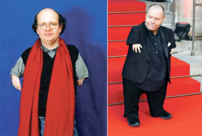 Среди известных жертв талидомида - немецкий документалист Нико фон Глазов и оперный певец Томас Квастхофф