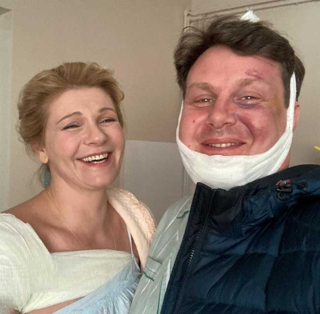 "Передрались из-за большой любви": Анну Ардову застукали с перебинтованным мужчиной