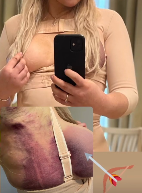 «Сиси-тряпочки»: Дана Борисова выставила напоказ изуродованную грудь