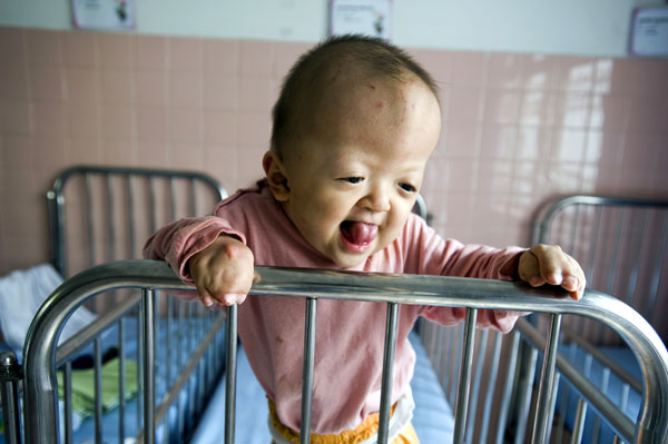 Последствия воздействия «агента оранж» сказываются на вьетнамских детях по сей день