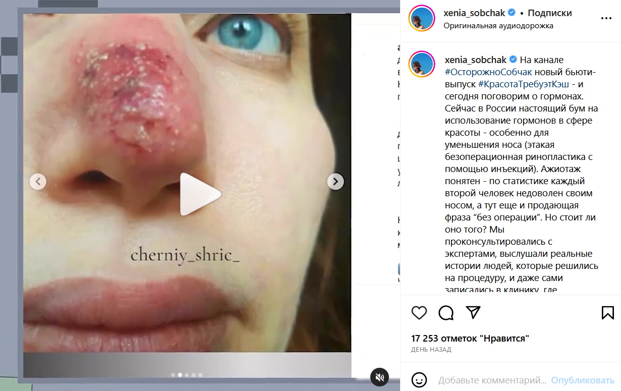 Уменьшила нос: Ксения Собчак показала печальный результат неудачной пластики