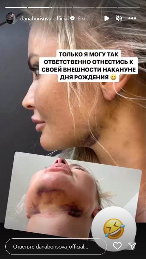Одутловатая Дана Борисова показала почерневшую голову: пятна и кровоподтеки