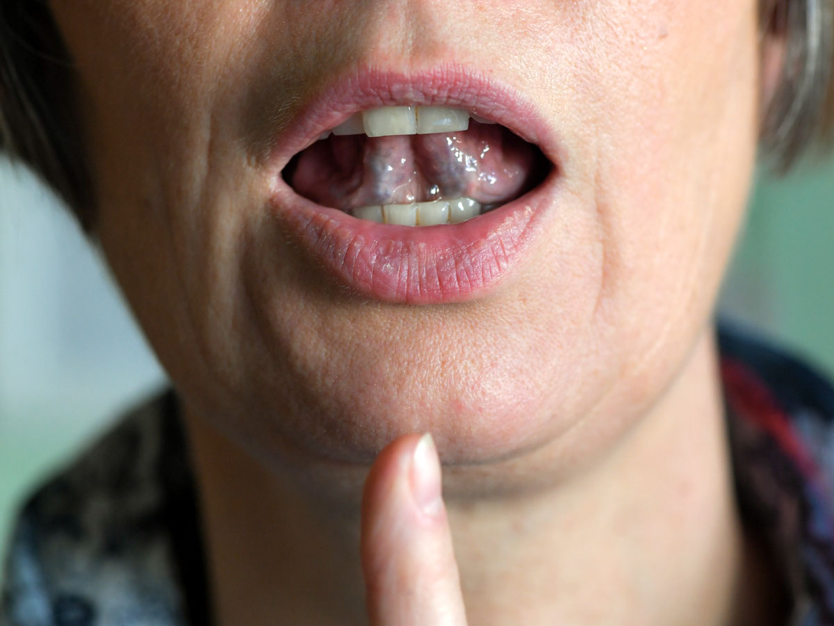 Рак языка легко спутать с сифилисом
