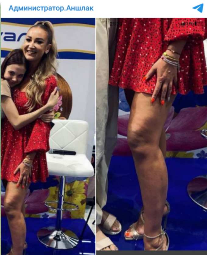 Дряблые коленки, целлюлит и раздувшееся тело: честное фото Бузовой слили в Сеть