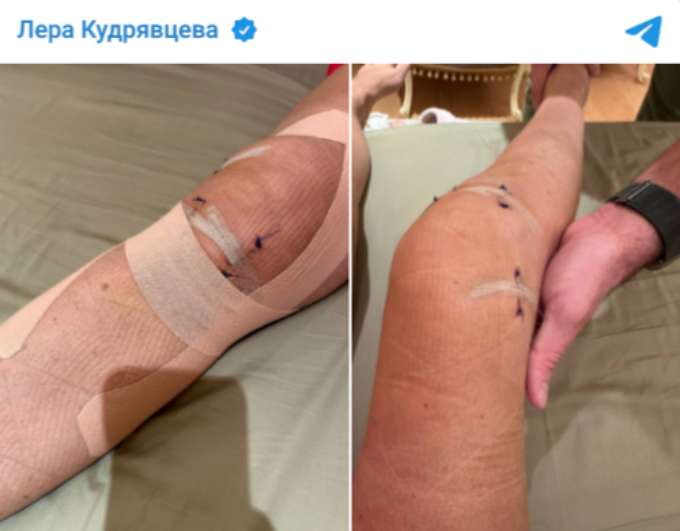 «Нога была обескровлена»: врач раскрыл жуткие подробности операции Кудрявцевой