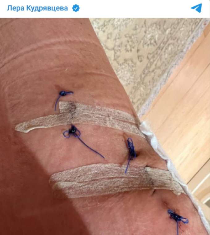 Торчат нитки, ступня почернела: как живет беспомощная после операции Кудрявцева