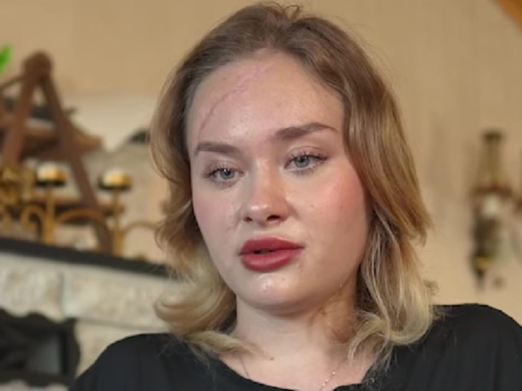 Инвалидное кресло и огромный шрам на лице: избитая в Дубае Мария Ковальчук рассказала, что на самом деле с ней произошло