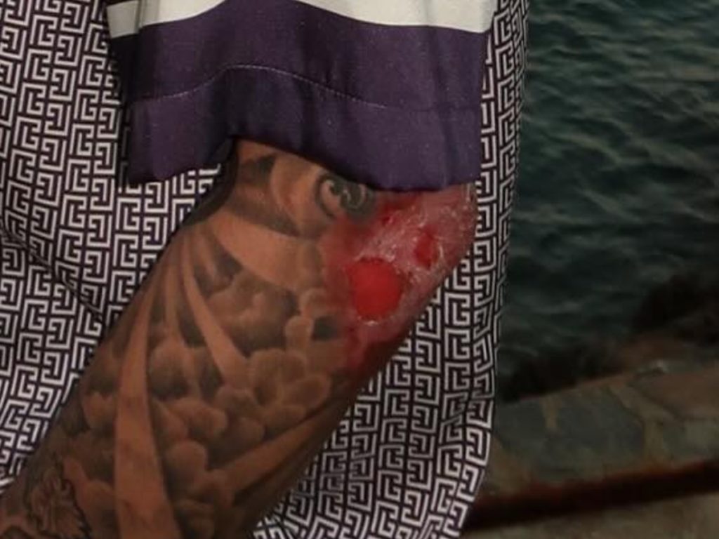 Филипп Киркоров показал незаживающие из-за диабета ожоги: «Вместе с кожей стащили костюм»