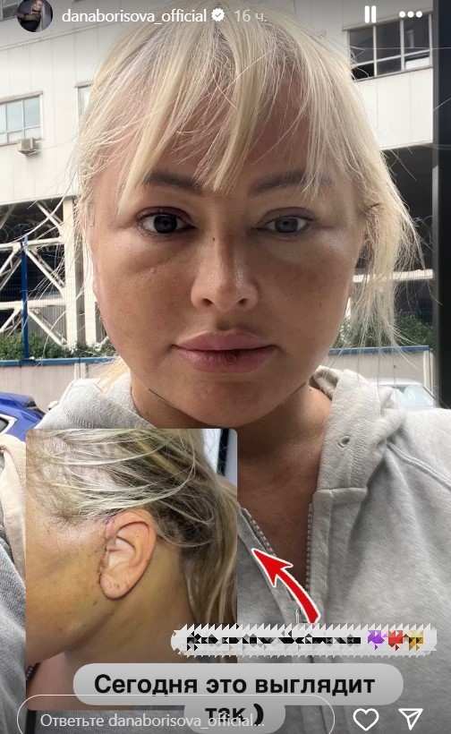 Один глаз больше другого: результаты пластики Даны Борисовой пугают