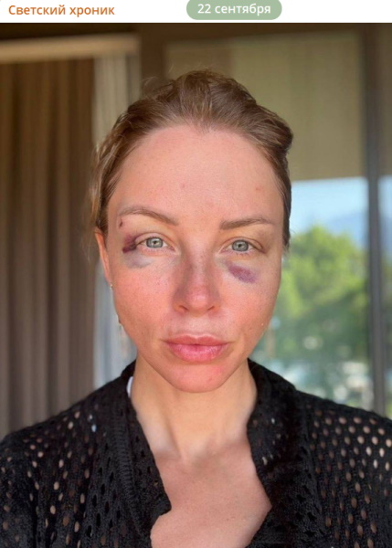 Последствия пластики выдавала за травмы: Полина Диброва пыталась подставить жену Романа Товстика?