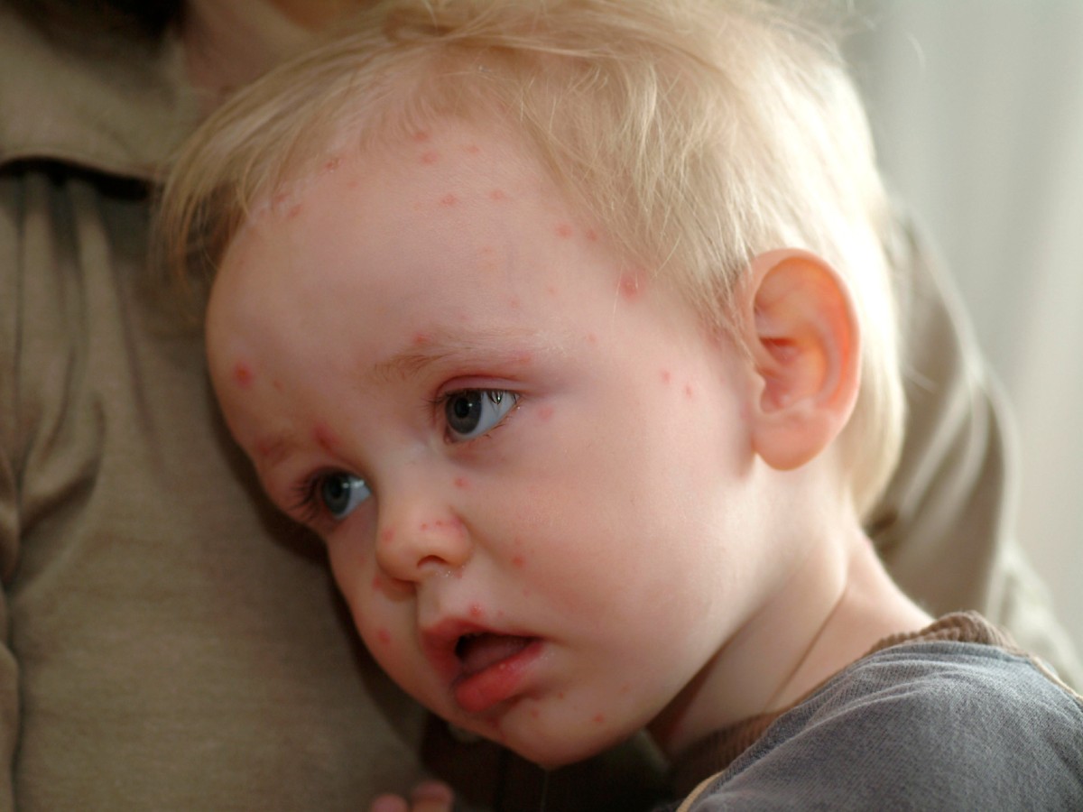 «Прививка достается только самым упорным»: заболеваемость ветрянкой стремительно растет в России