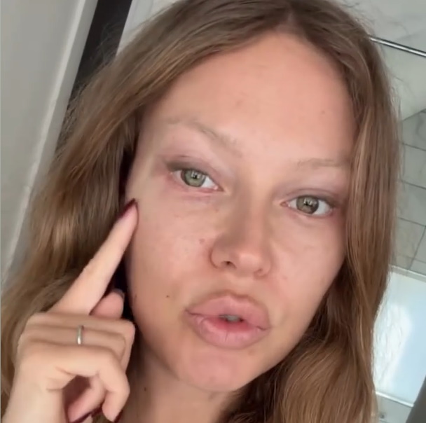 «Может быть, я буду ходить так всегда»: ставшая жертвой неудачной пластики Дакота показала «дыру в щеке»