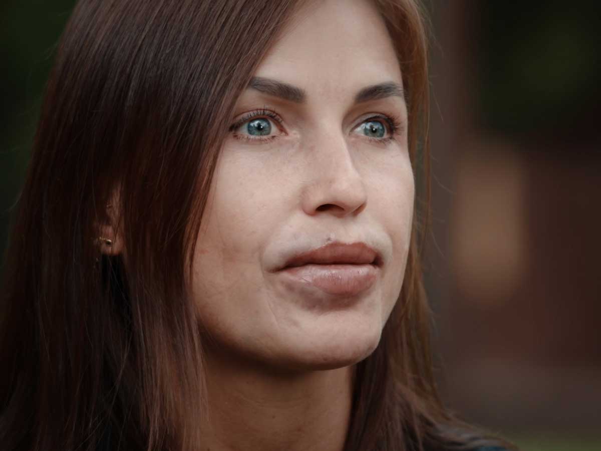 «Я не могла ни есть, ни пить»: женщина едва не лишились губ после инъекций вазелина