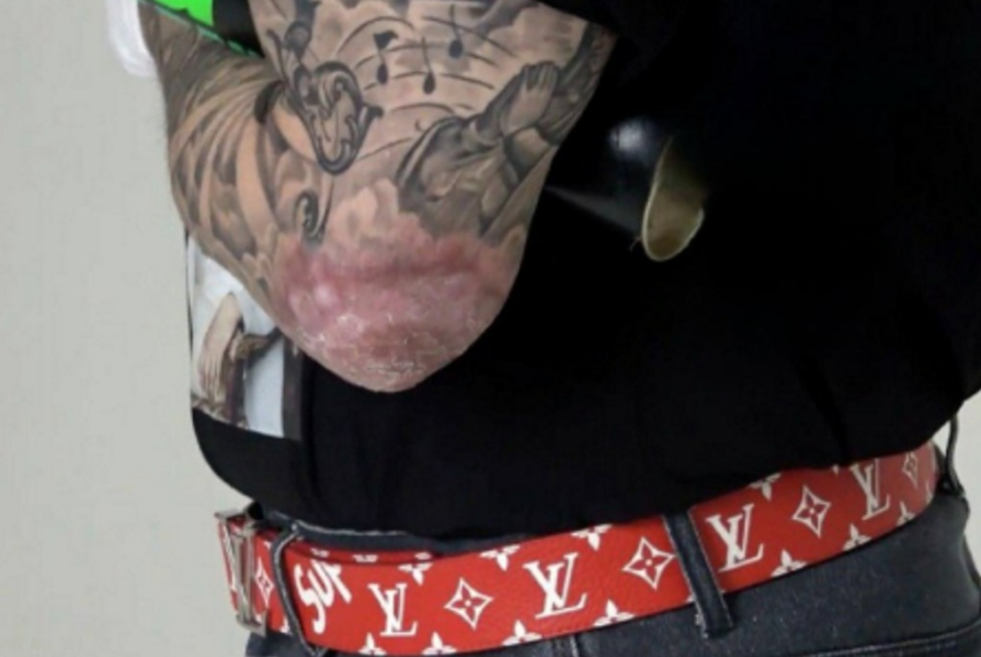 «Диабет, псориаз, неудачная пластика?» Жуткий ожог на руке Киркорова напугал поклонников