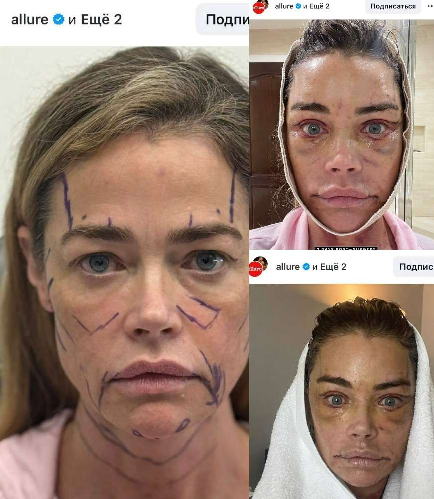 «Мои старшие дочери были недовольны»: что пластический хирург сделал с лицом звезды 90-х Дениз Ричардс (фото)