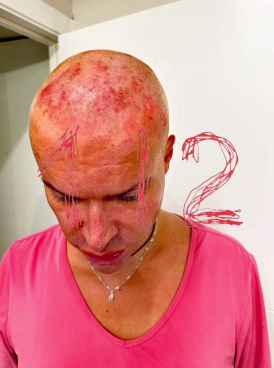 «Вся голова красная, обожженная, в волдырях»: Гогена Солнцева изувечили в Москве