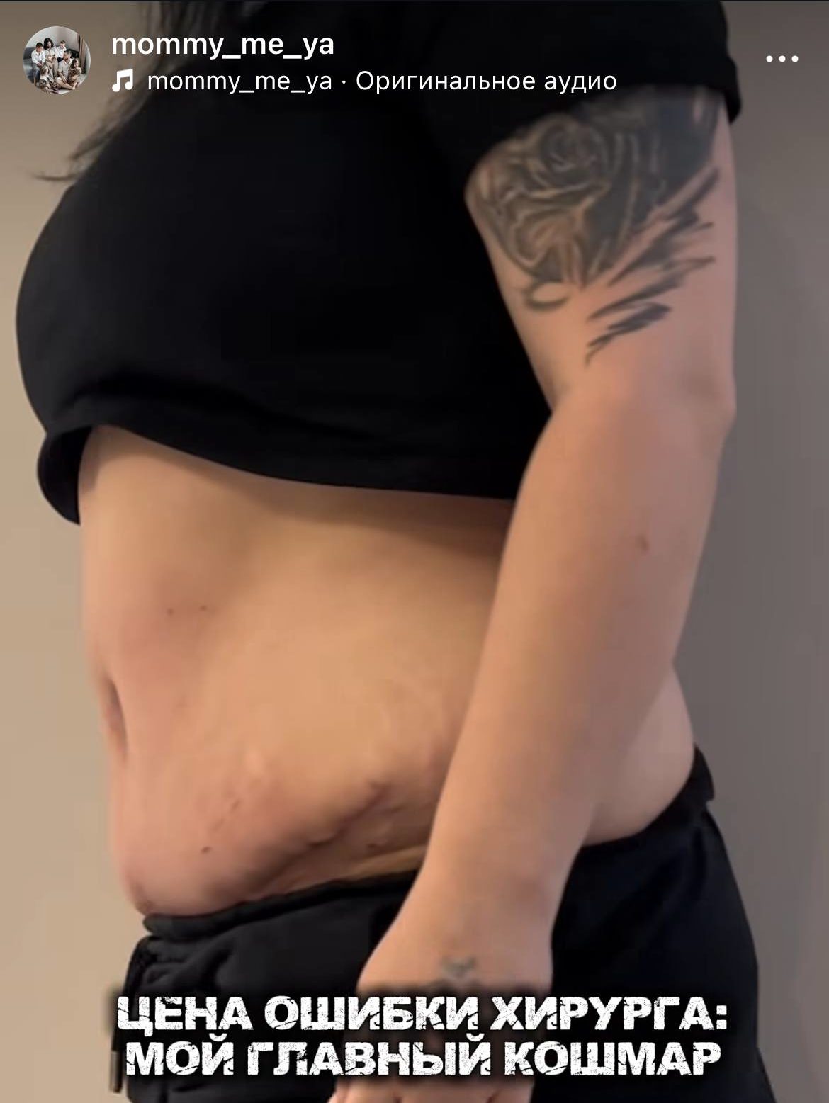 «Пупок снова оторвался»: Александра Стриженова рассказала о провальной пластике