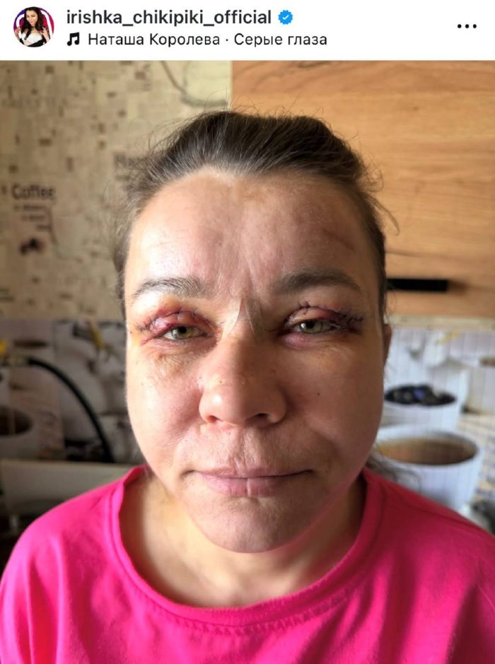 «В морге аккуратнее зашивают»: как выглядит лицо Иришки Чики-Пики после пластики
