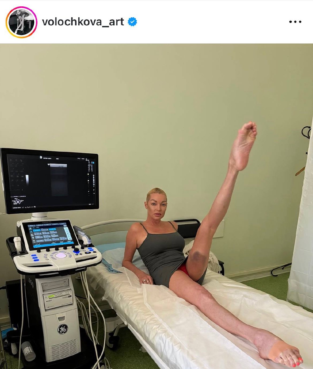 Анастасия Волочкова вышла на связь из больницы и показала страшно почерневшую ногу: фото