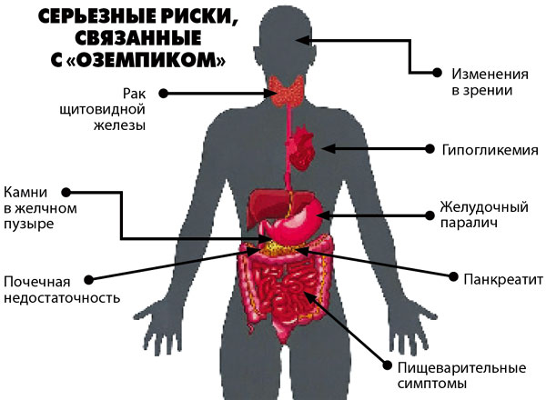 «Оземпик»