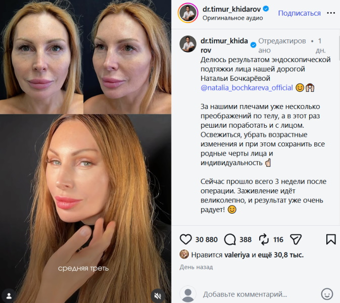 «Отекшая уточка»: в Сети оценили очередную пластику Натальи Бочкаревой